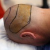 Scalp Flap Surgery