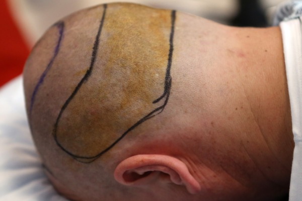 Scalp Flap Surgery Information Image