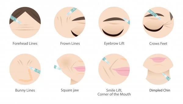 Common areas Botox can treat
