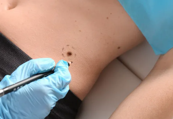 Mole removal