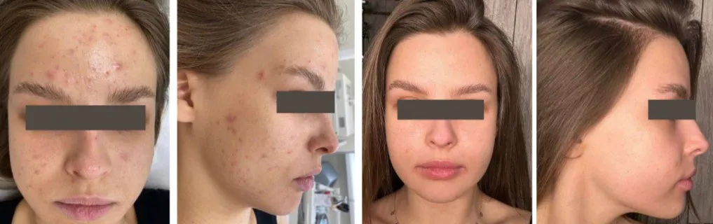 Acne Before and after images