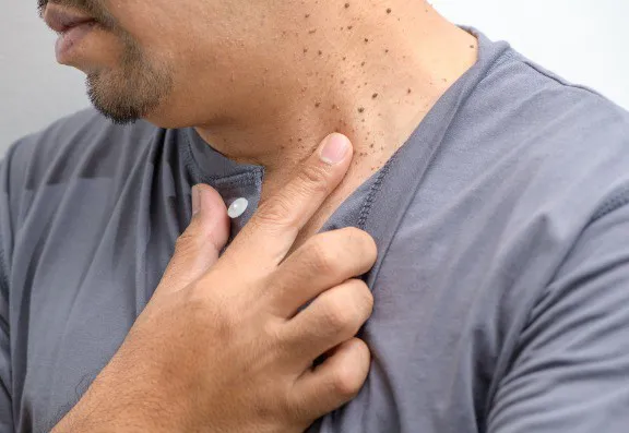 Not Yet Using Fractional Plasma Technology for Skin Tag Removal? It May Be Worth Considering Not Yet Using Fractional Plasma Technology for Skin Tag Removal? It May Be Worth Considering