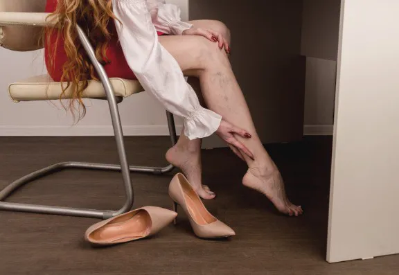 Varicose Vein Treatments