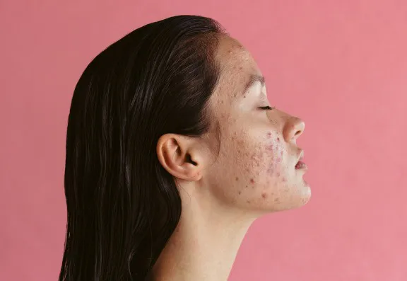 Acne trial shows improvement using light therapy