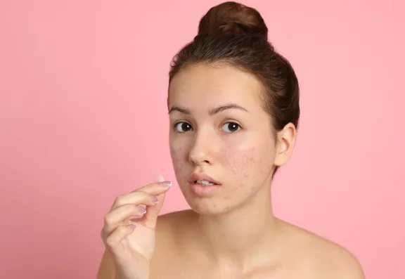 Treatment for Acne