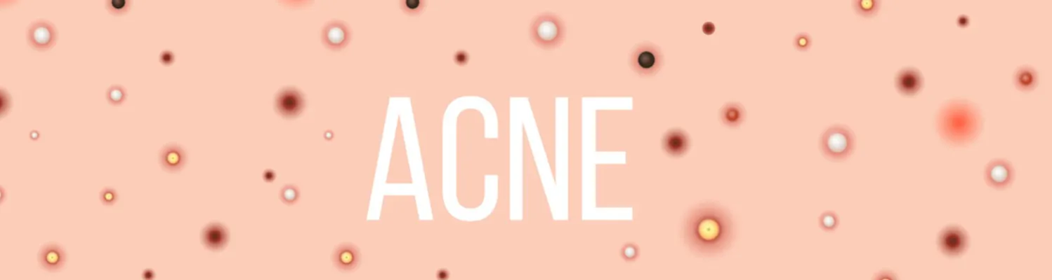 Acne Trial Shows Improvement Using Blue Light Therapy