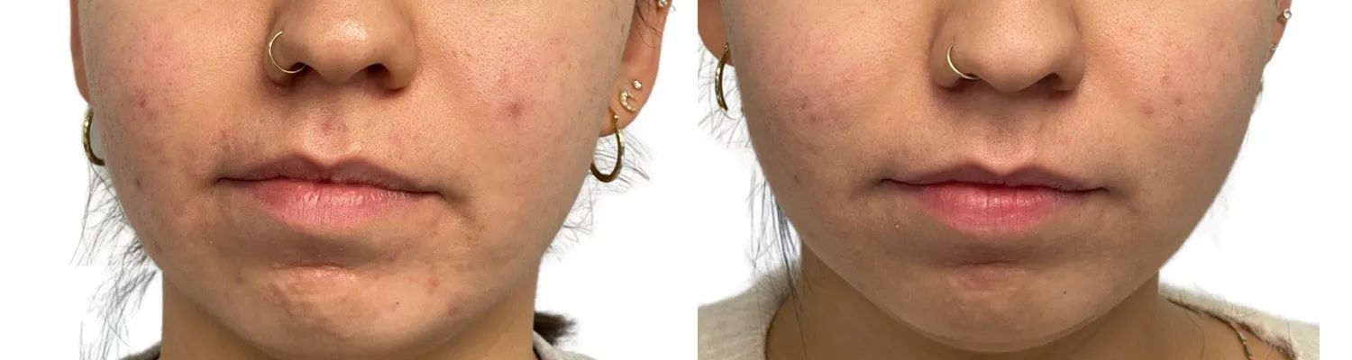 AMP Takes All-In-One Facials to the Next Level