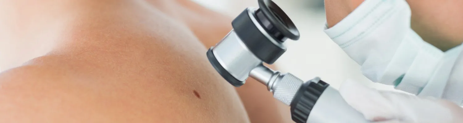 An Expert Guide to Mole Removal