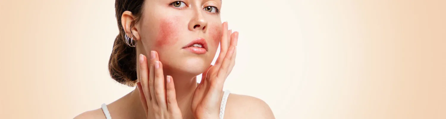 Botulinum Toxin's Efficacy and Safety for Rosacea Treatment