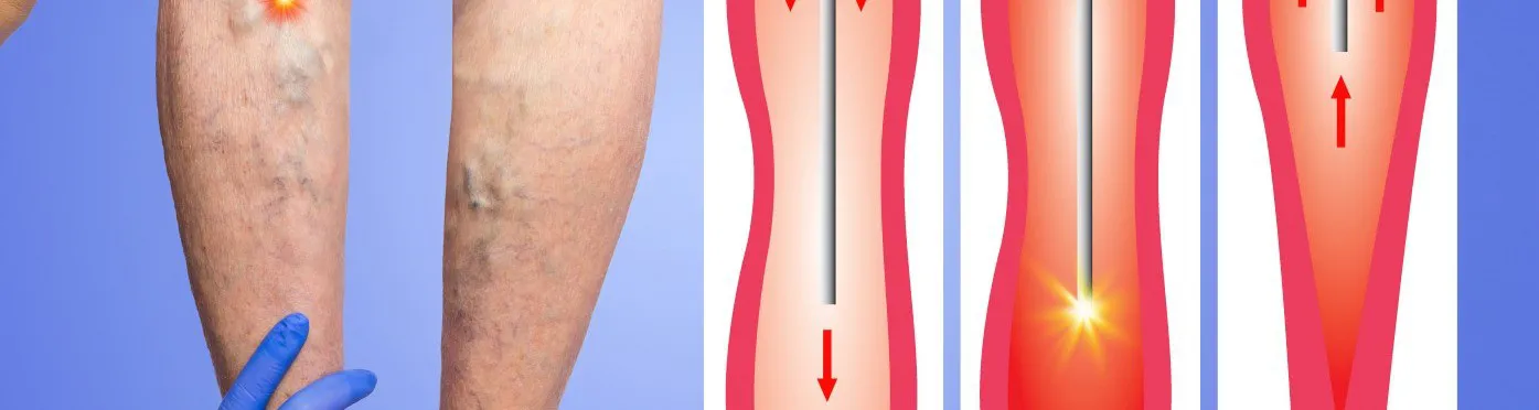 Changes to NHS Funding of Varicose Vein Procedures