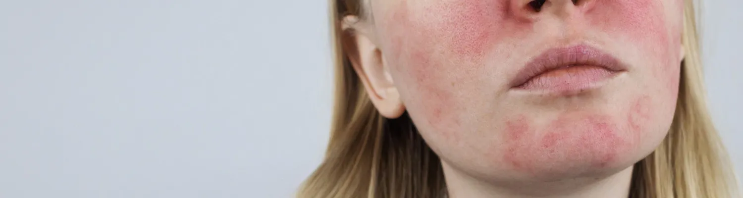 Clinical Study: A Breakthrough for Rosacea: Tackling Persistent Redness and Flushing with Tixel and Botulinum Toxin