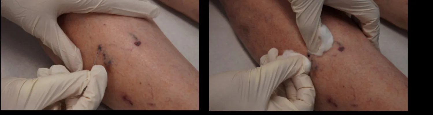 How to Avoid Brown Marks and Staining After Sclerotherapy