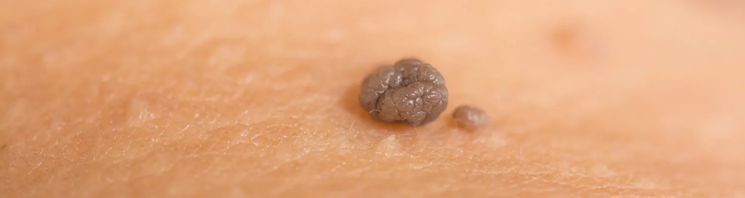 How to Spot a Melanoma