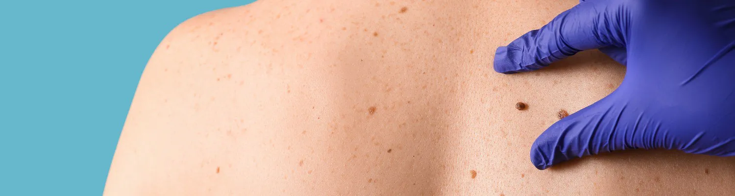 Is There Such a Thing as an App to Diagnose Skin Cancer?