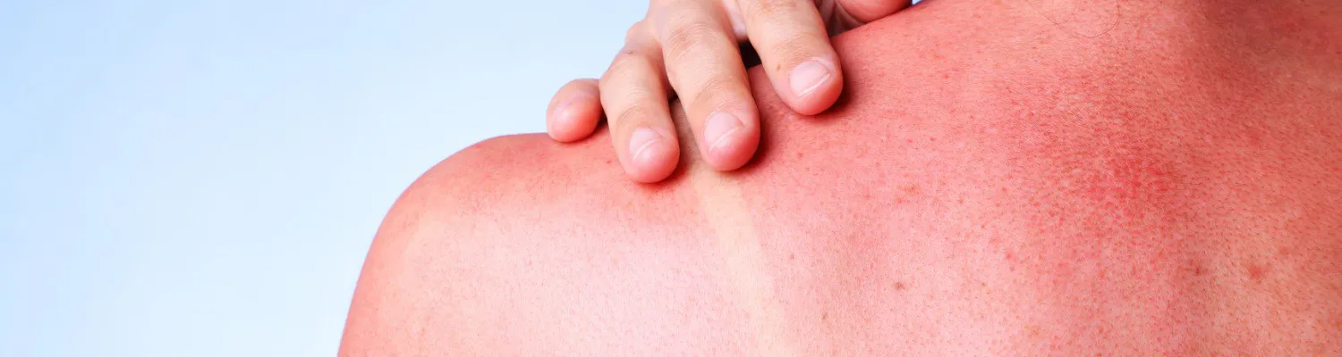 More Than Half of Brits Get Sunburnt Accidentally