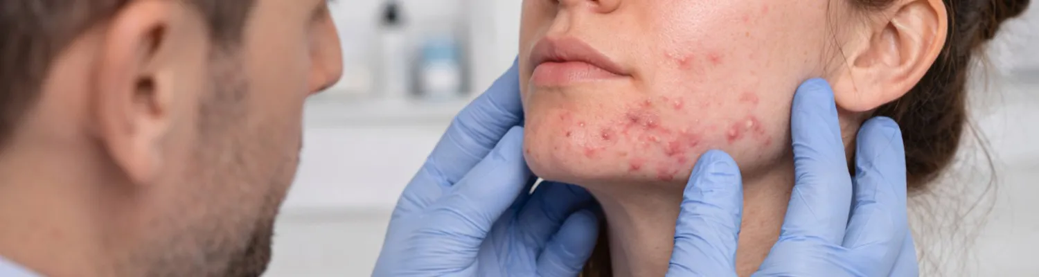 New Acne FAQ Now Live, and How Clinics Can Use It