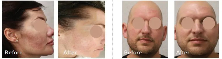 New Clinical Evidence for Rosacea: Alpha Pro 3D IPL in Focus