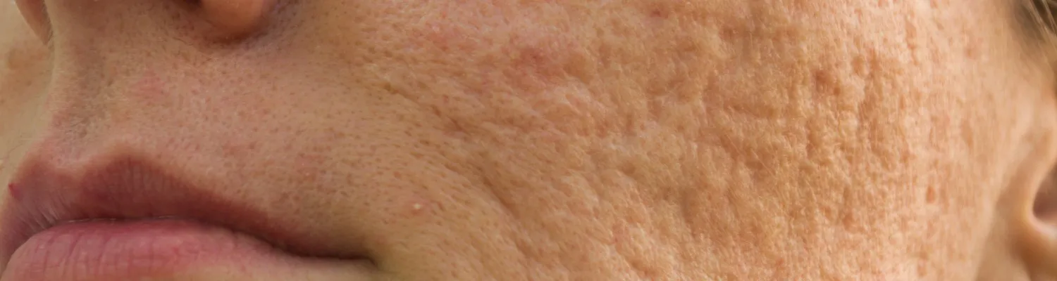 Understanding Scars