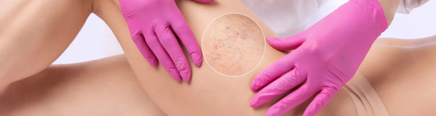 What is the Best Sclerosant for Microsclerotherapy in 2024?