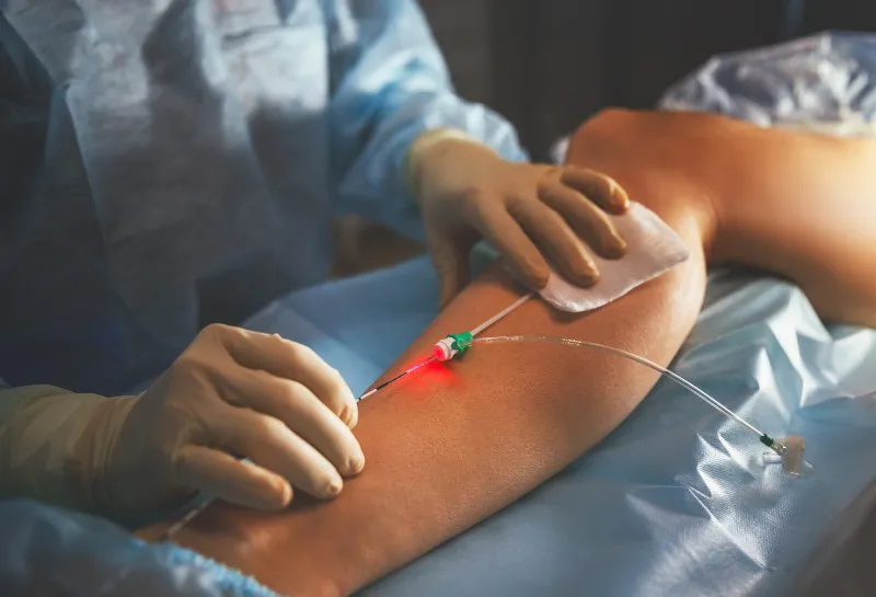 7 Steps to Safe Treatment of Leg Spider Veins by Sclerotherapy
