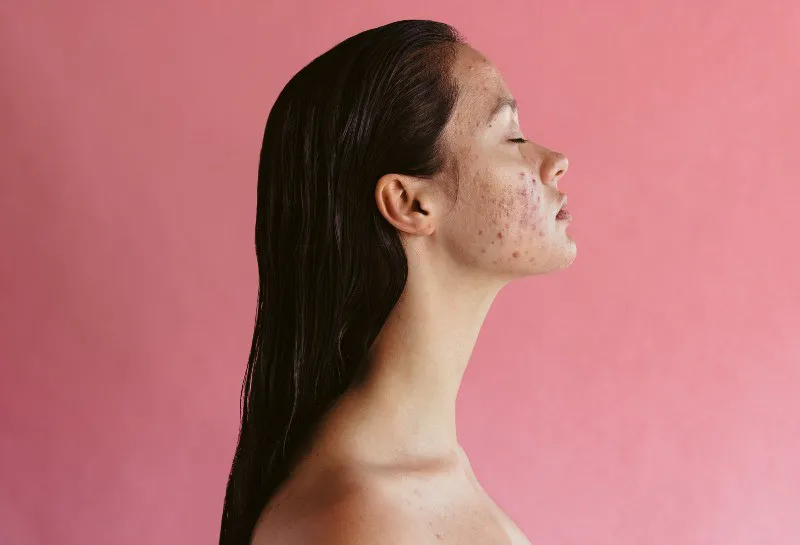 Acne Trial Shows Improvement Using Blue Light Therapy