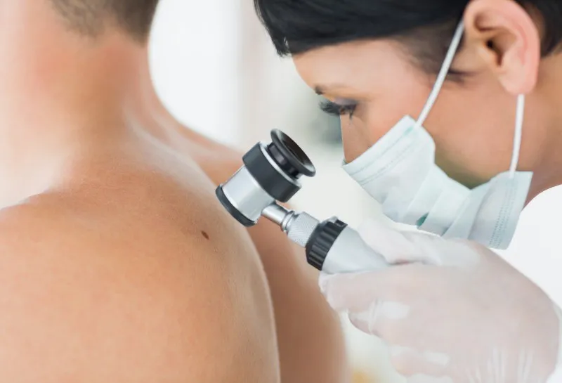 An Expert Guide to Mole Removal