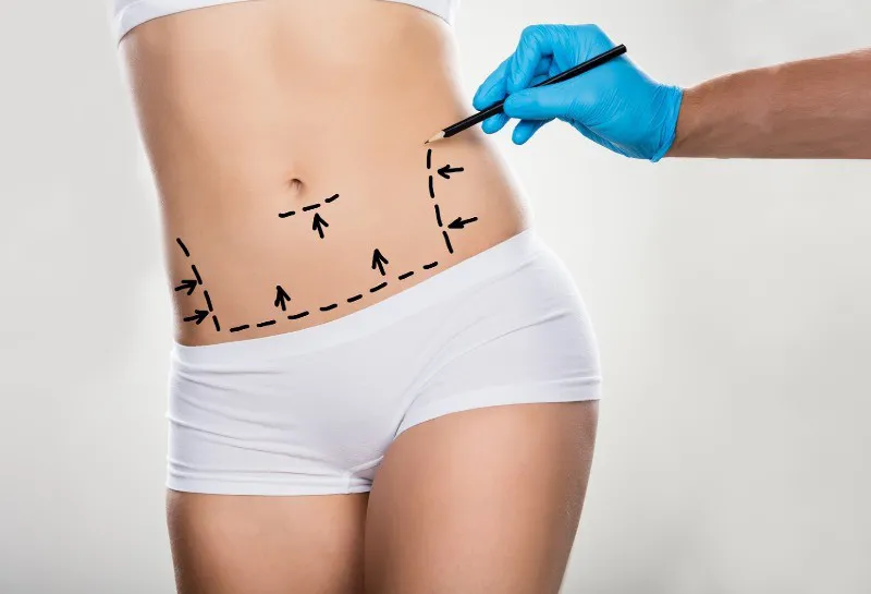 BABTAC Comments on ‘Alarming’ Liposuction Courses Offered to Non-medics