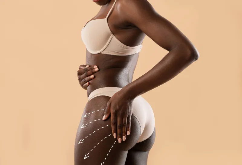 City Council Serves Notice on ‘Brazilian Butt Lifts’