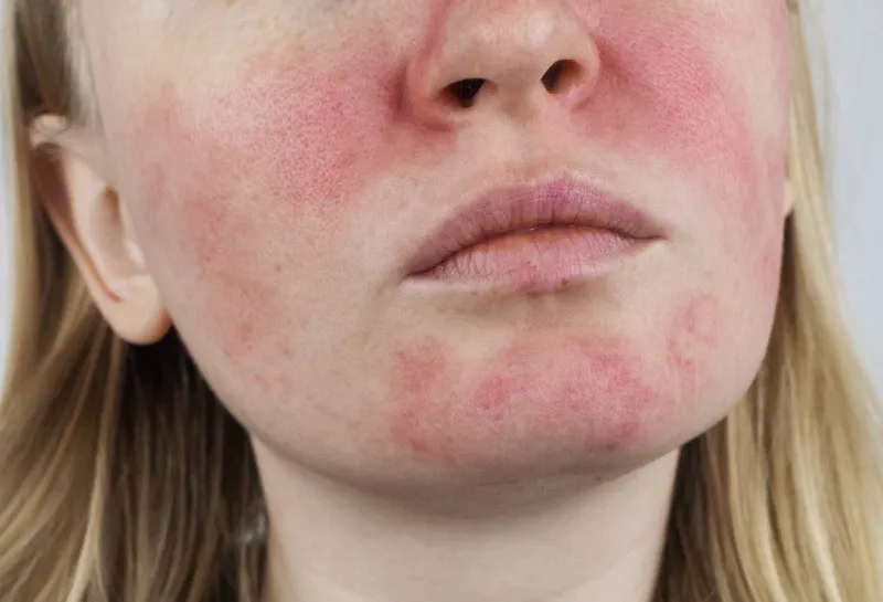 Clinical Study: A Breakthrough for Rosacea: Tackling Persistent Redness and Flushing with Tixel and Botulinum Toxin