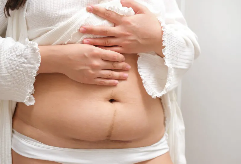 C-Section Scars: How Stress Can Affect Healing and Recovery