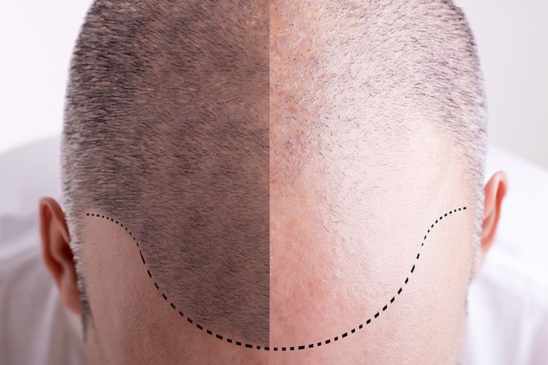 ISHRS Launches Awareness of Black Market Hair Restoration