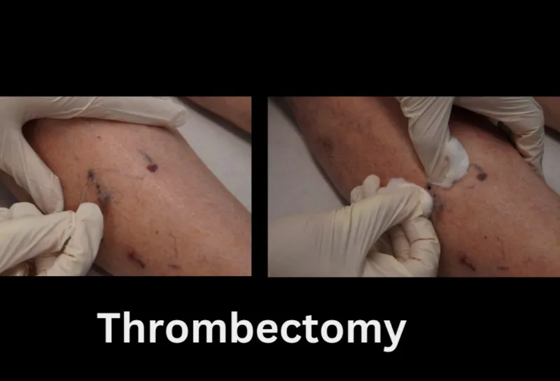 How to Avoid Brown Marks and Staining After Sclerotherapy