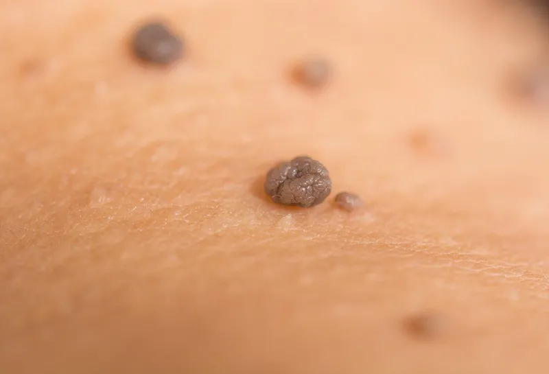 Is There Such a Thing as an App to Diagnose Skin Cancer?