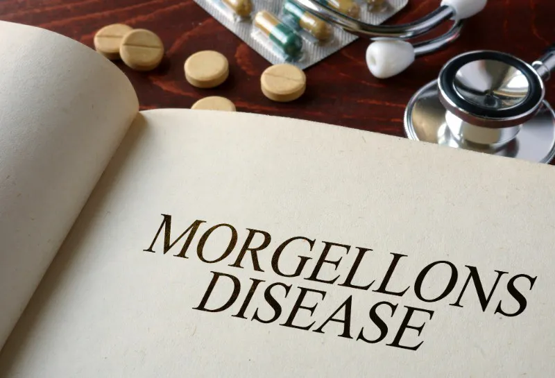 Morgellons: Is the Mystery Condition Solved at Last?