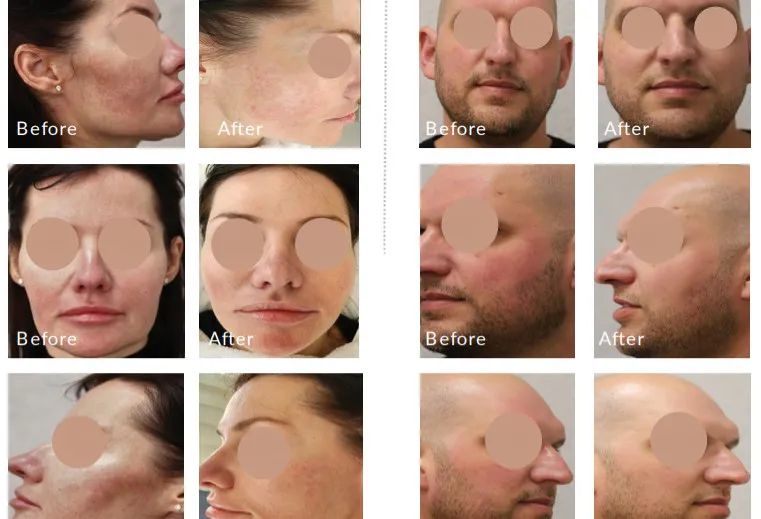 New Clinical Evidence for Rosacea: Alpha Pro 3D IPL in Focus