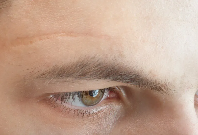 The Fault in Our Scars: Scarring and Young People