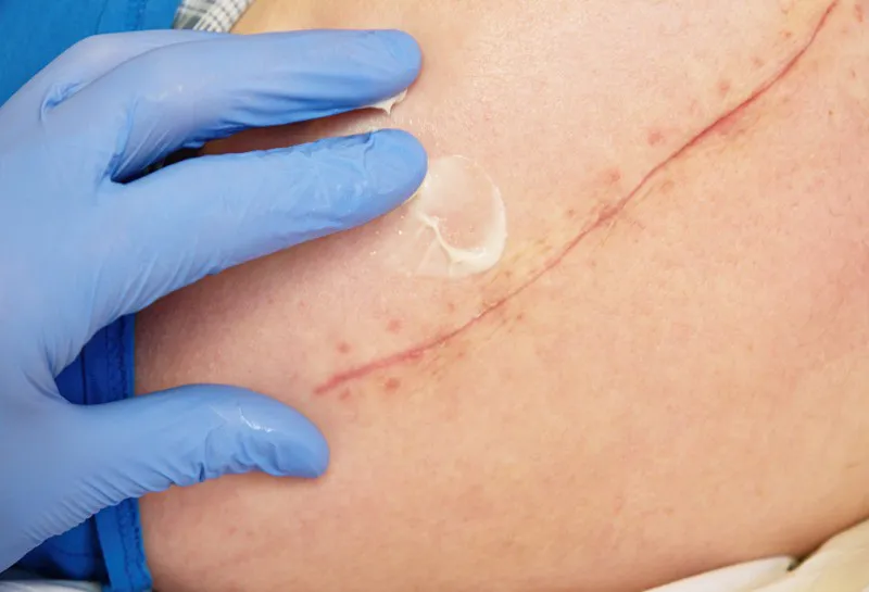 Understanding Scars