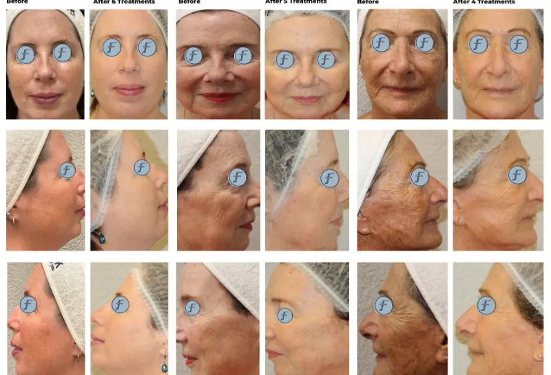 Unlocking the Potential of the Tight & Bright Protocol: A Case Study on Advanced IPL Rejuvenation