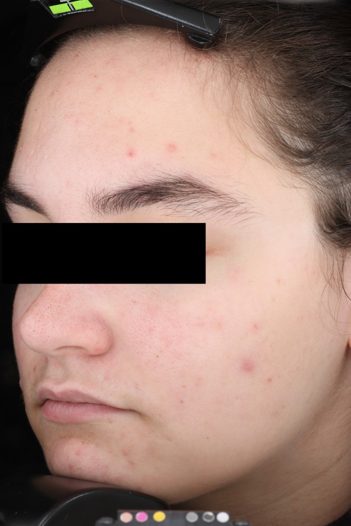 AlumierMD Before Treatment