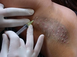 Botulinum toxin hyperhidrosis, Armpit botulinum