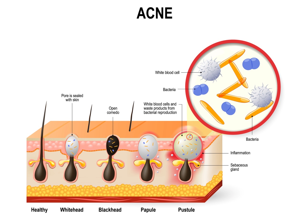 Illustration of Acne