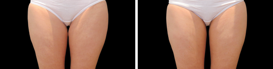 Before and After CoolSculpting
