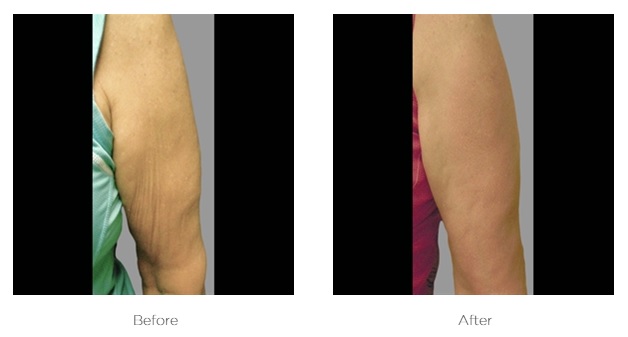 Exilis_Before_and_After_Arm