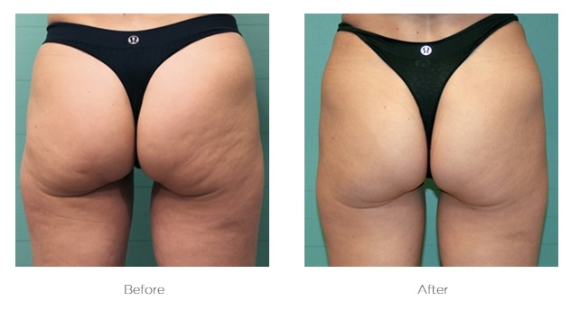 Exilis_Before_and_After_Buttocks