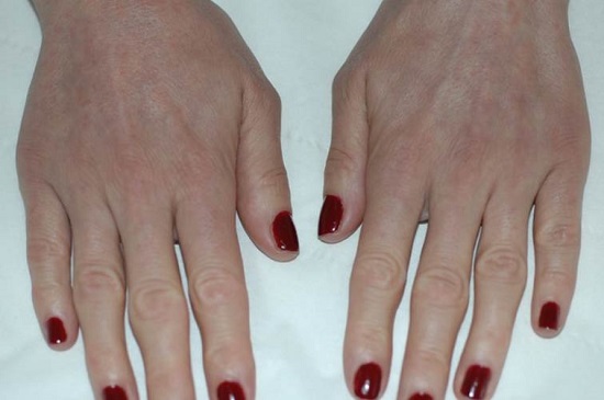 Female Hand Rejuvenation After Redexis