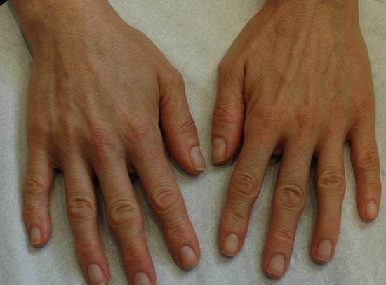 Female Hand Rejuvenation Before Redexis Image