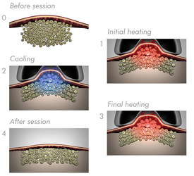 LipoContrast Animation