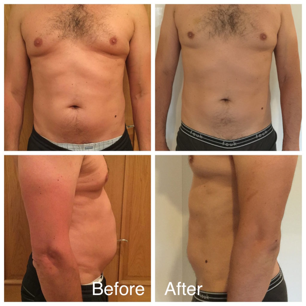 LipoContrast Before and After Male