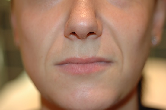 Lips Before Revanesse Image
