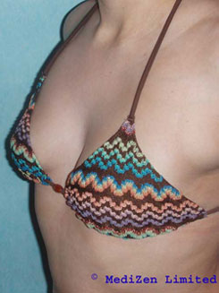 Breasts Before Macrolane Treatment